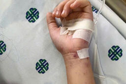 Bệnh não mô cầu, đừng chờ nổi ban mới đi viện